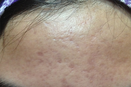 acne-after