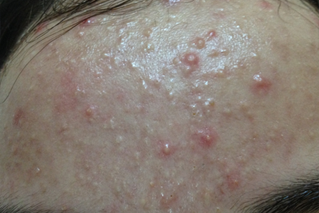 acne-before