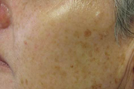 pigmentation-before